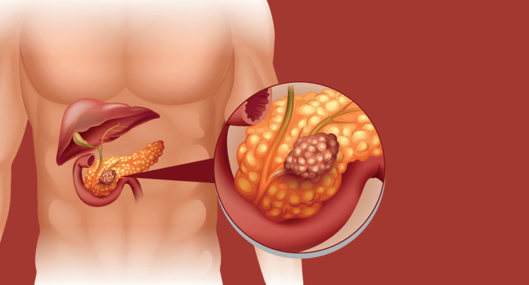 Recognizing 5 Warning Signals of Pancreatic Issues