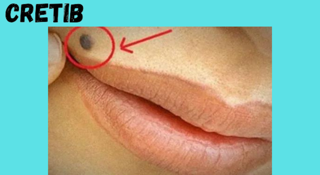 IF YOUHAVE A MOLE AT ONE OF THESE 7 PLACES ON YOUR BODYTHIS IS WHAT IT MEANS. YOU WILL BE SURPRISED!
