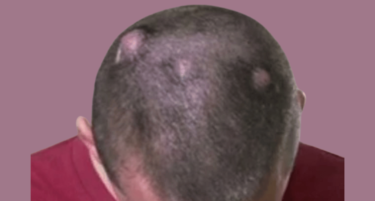 IT LOOKS LIKE A PIMPLE ON HIS HEAD, BUT WHAT THEY PULLED OUT SHOCKED THEM