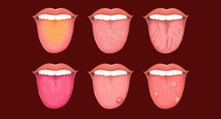 What Your Tongue Says About Your Health